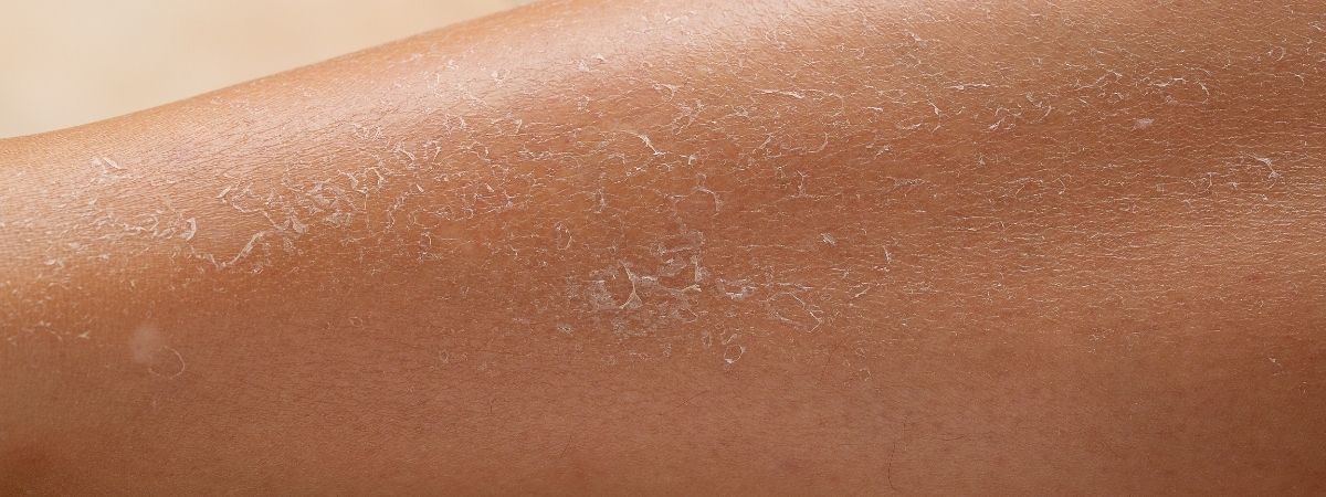 Droge en schilferige huid